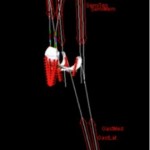 Knee 150x150 Modeling a subject specific Knee model using rigid body dynamics